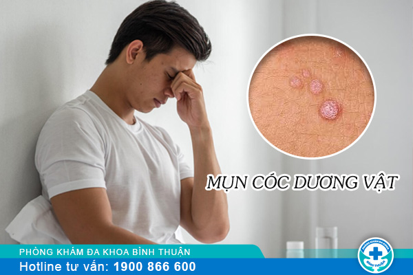 Nam giới bị nổi mụn cóc dương vật phải làm sao?
