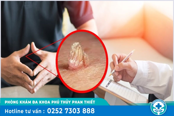 Bệnh sùi mào gà ở bao quy đầu: Dấu hiệu và Cách khắc phục hiệu quả