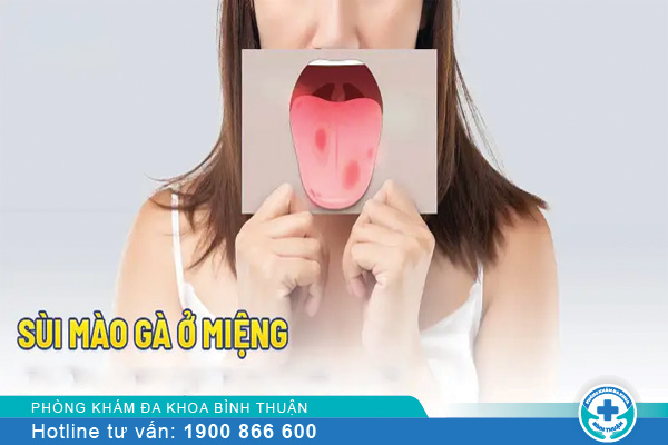 Sùi mào gà ở miệng, lưỡi là gì? Nguyên nhân do đâu?
