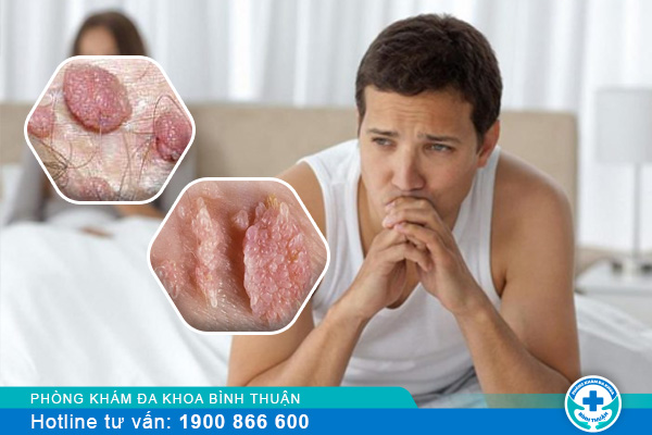 Một số dấu hiệu sùi mào gà ở nam giới cần lưu ý